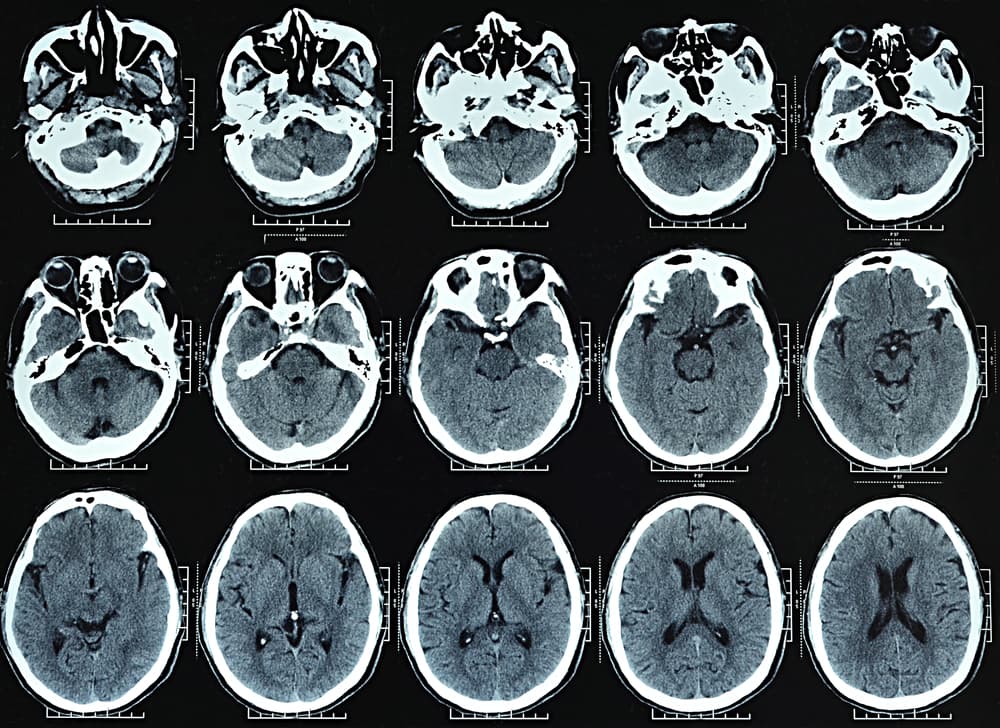 CT scan 1